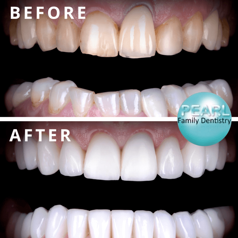 Before & After ClearCorrect Aligners