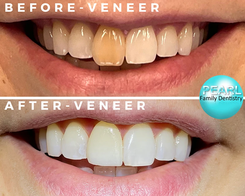 before and after image of dental veneers