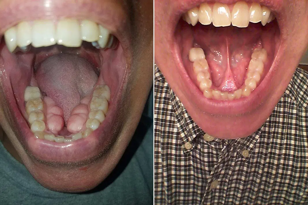 Understanding Torus Mandibularis and Mandibular Tori