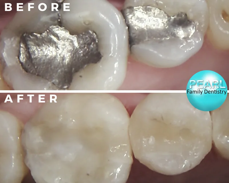 before and after image of amalgam filling replacements